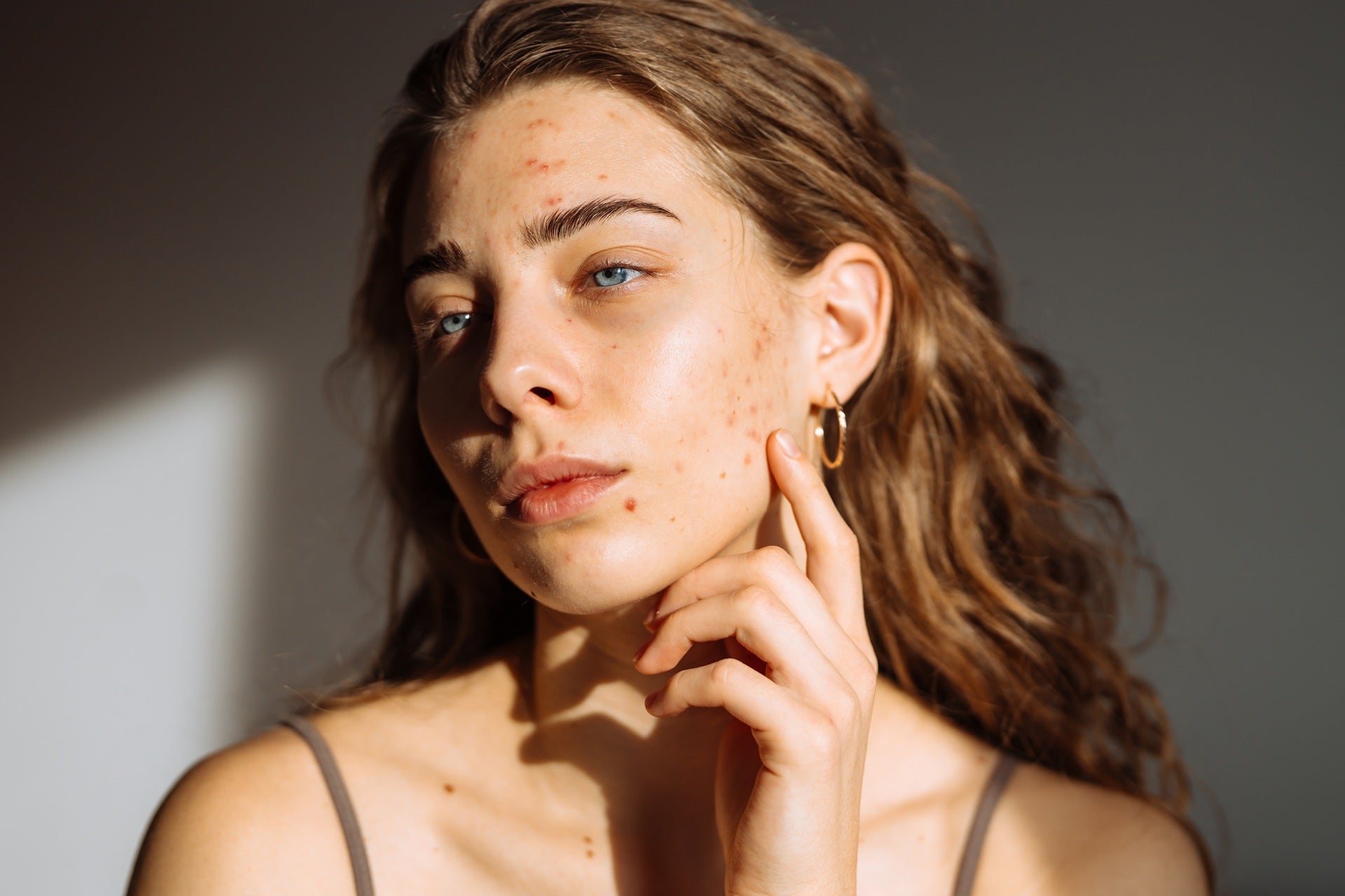 Acne Scar Treatments: How to Achieve Smoother, Clearer Skin - Wise Aesthetics