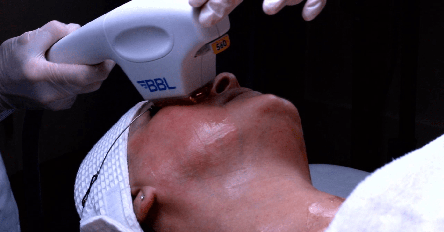 Halo™ + BBL® - Wise Aesthetics