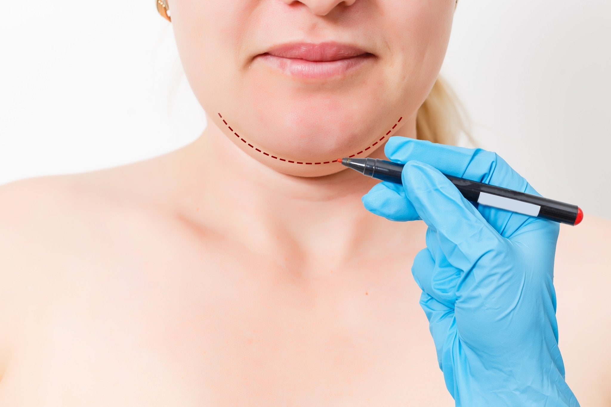 Kybella® & Deoxycholic Acid - Wise Aesthetics