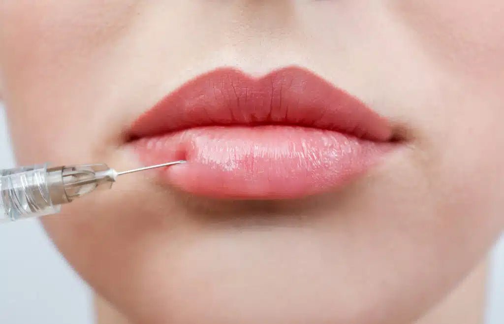 Lip Filler - Wise Aesthetics