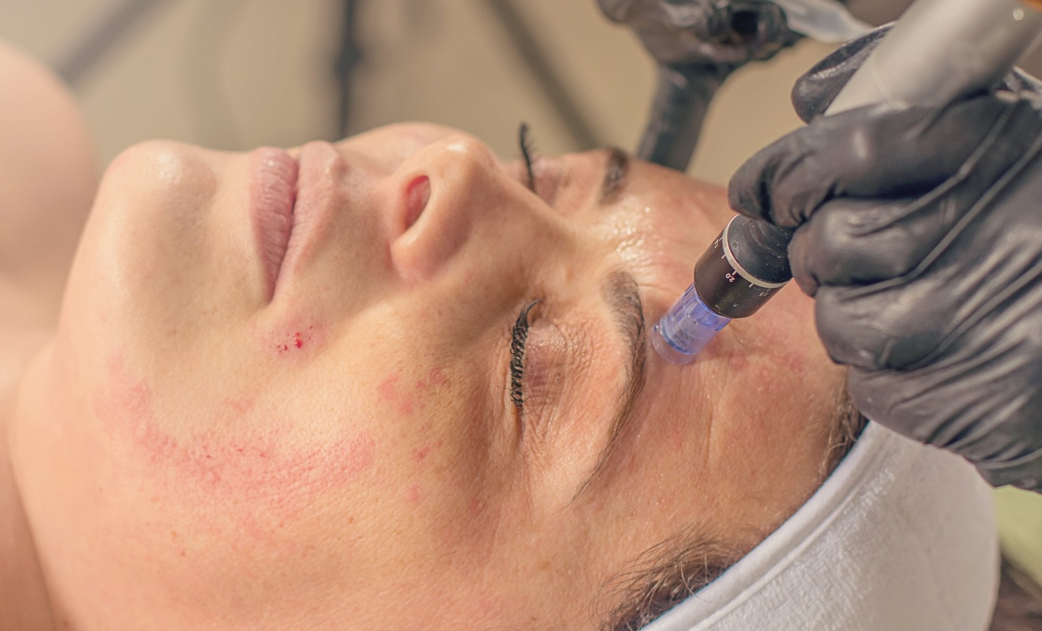 Microneedling - Wise Aesthetics