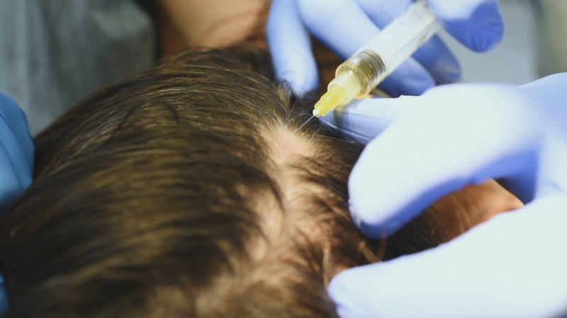 Nurse injector performing PRP therapy on the scalp of a middle-aged man to promote hair growth and scalp rejuvenation.