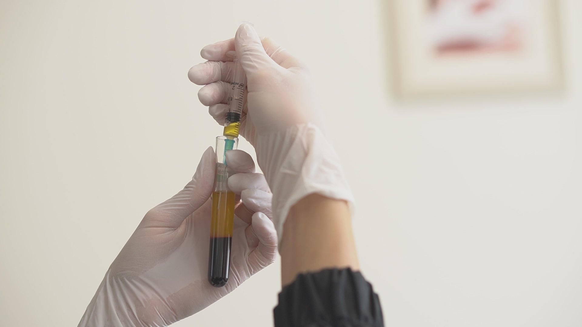 Load video: Nurse carefully drawing plasma from a PRP vial, preparing for a plasma injection treatment.