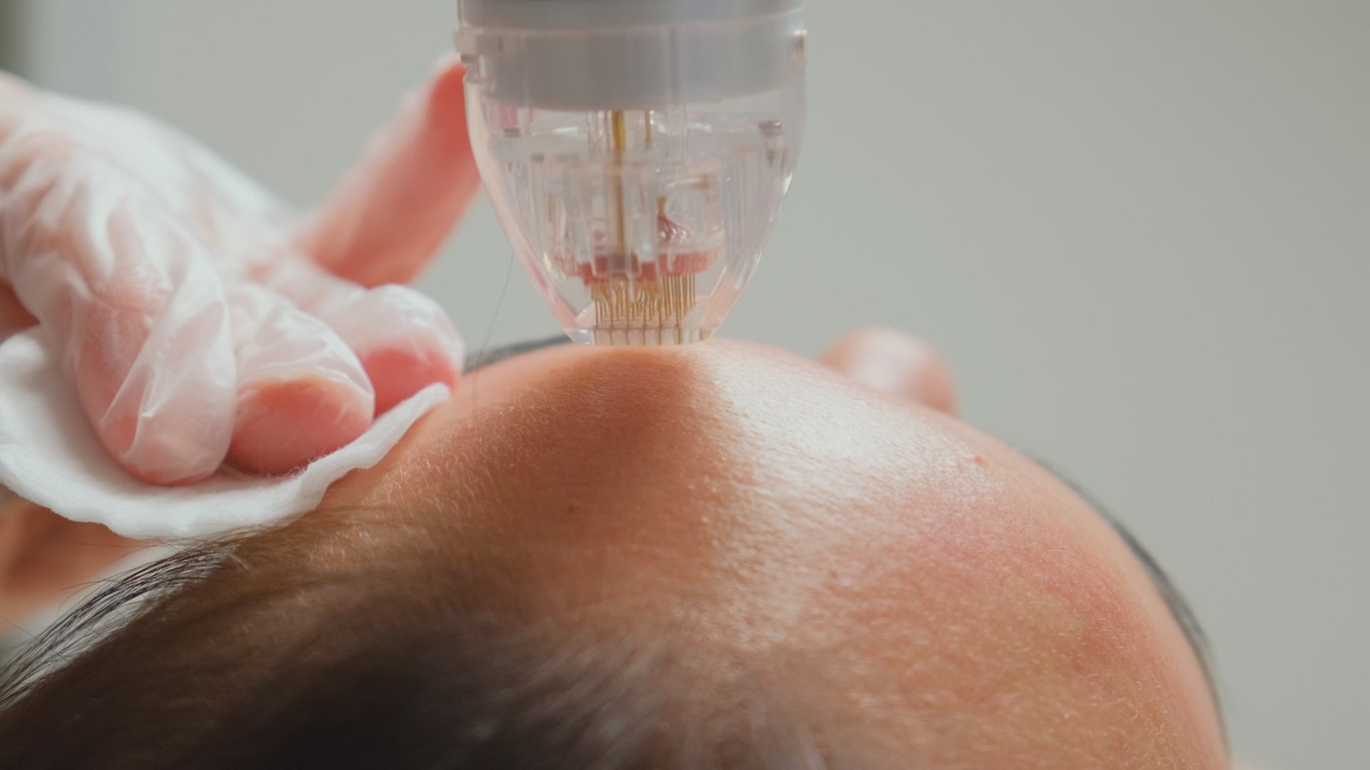 Load video: Medical professional performing RF microneedling treatment on a woman to improve skin texture and firmness.