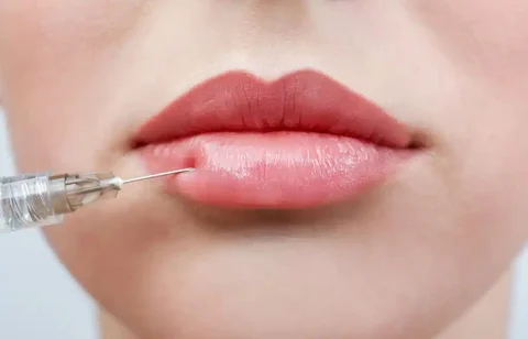 Lip Filler
