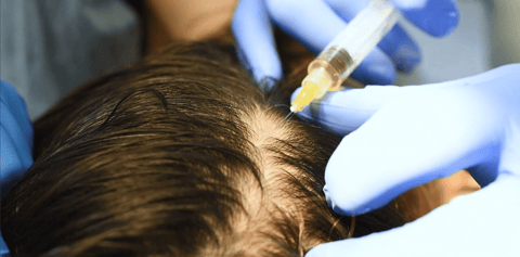 Plasma Hair Restoration