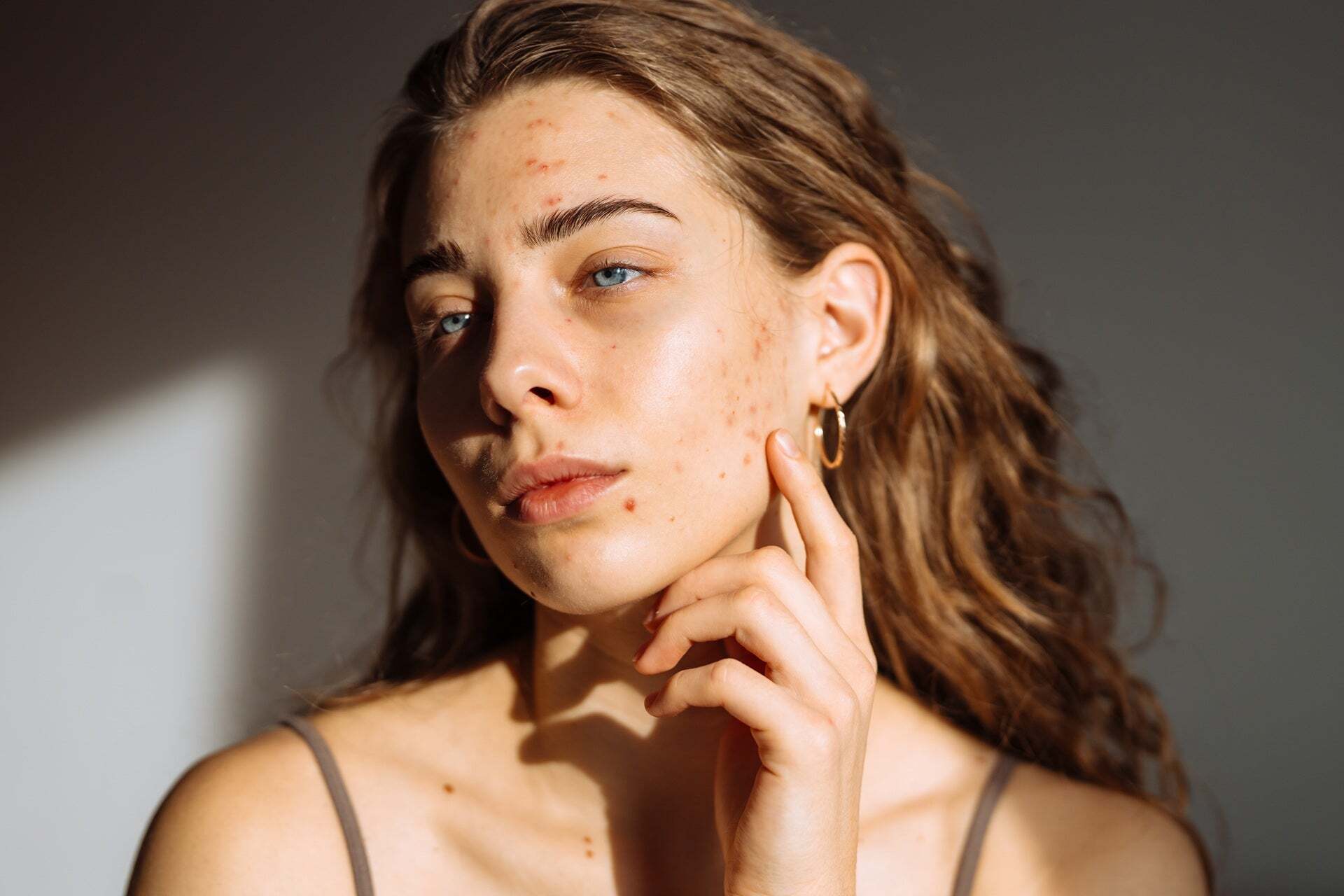 Acne Scar Treatments: How to Achieve Smoother, Clearer Skin