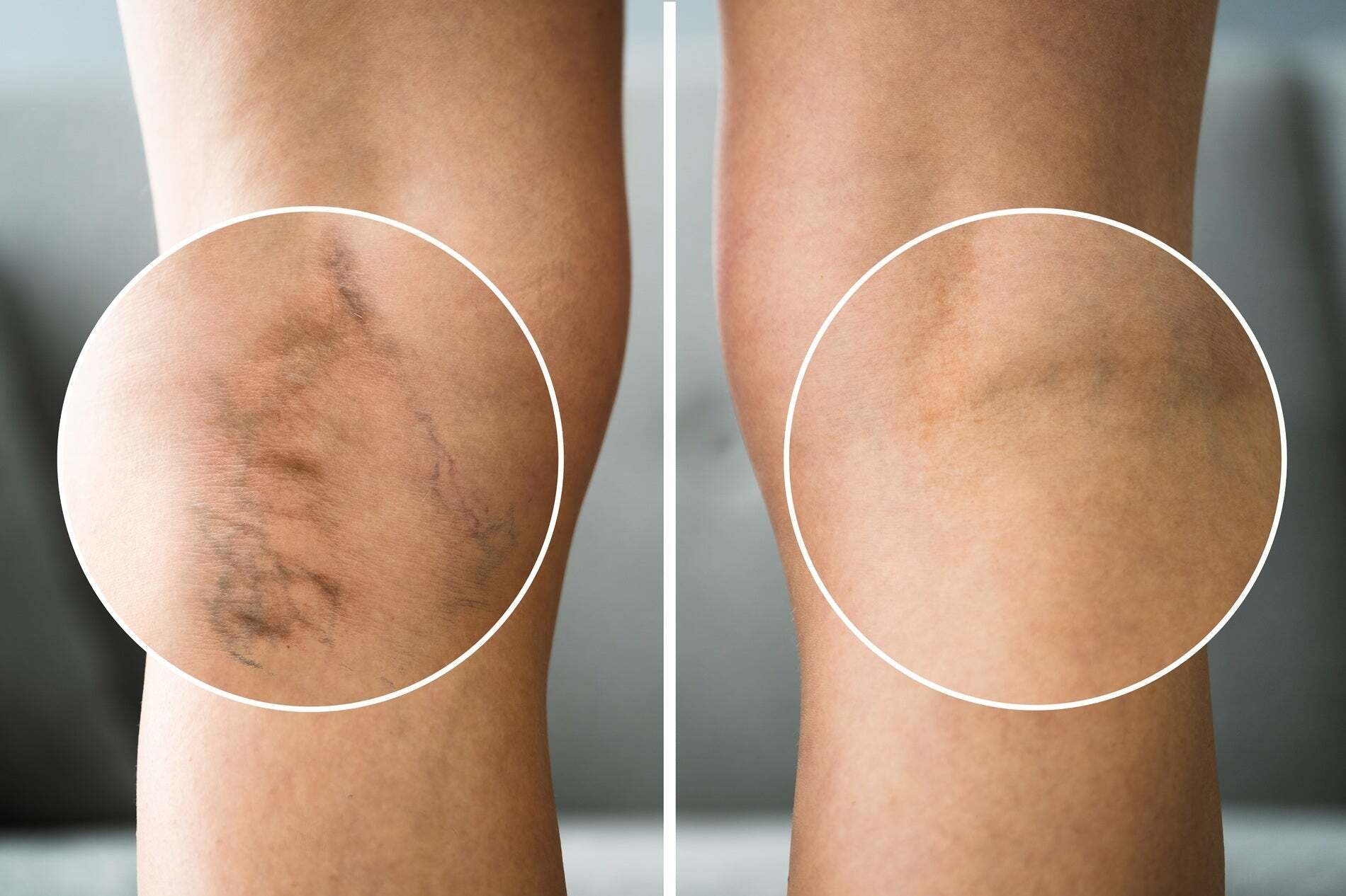Say Goodbye to Superficial Veins: How BBL and Laser Genesis Can Help