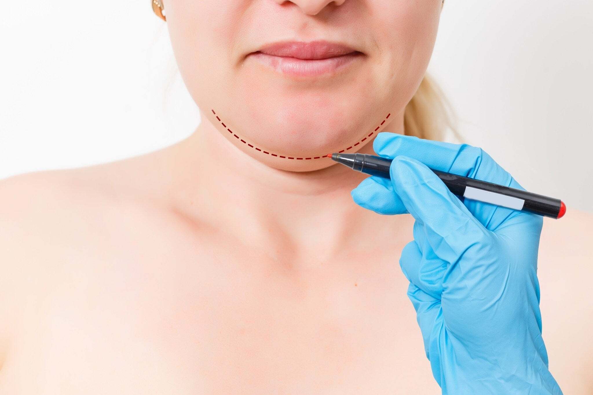 botox-woman (2)