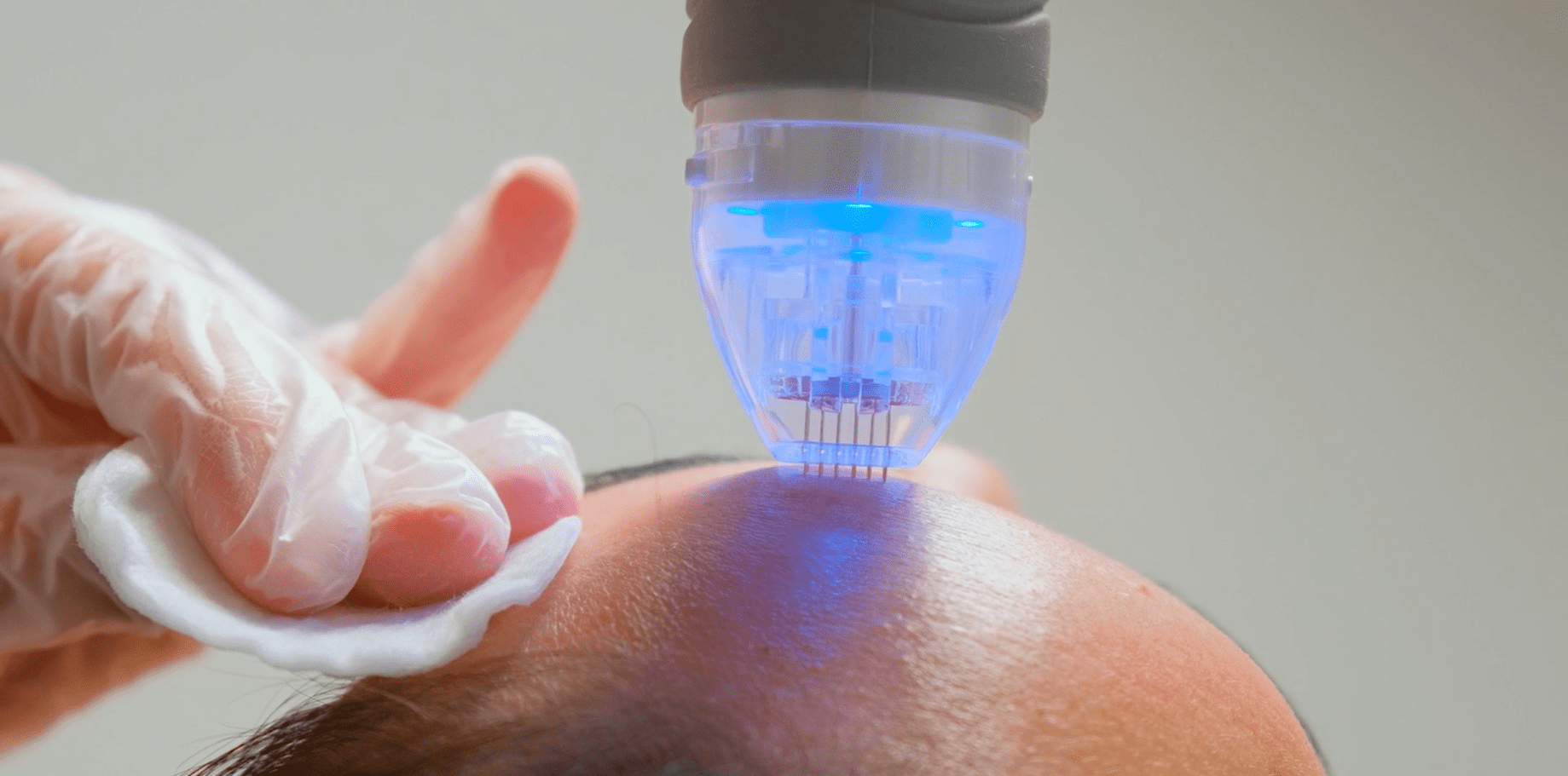 PRP VirtueRF Microneedling